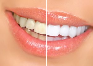 Teeth Whitening - Dental Loomis