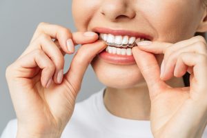 Invisalign - Dental Loomis